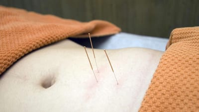 acupuncture, physiothérapie, bien être, relax, santé, cure, l'ostéopathie, thérapie, stress, acupuncture, acupuncture, acupuncture, acupuncture, acupuncture